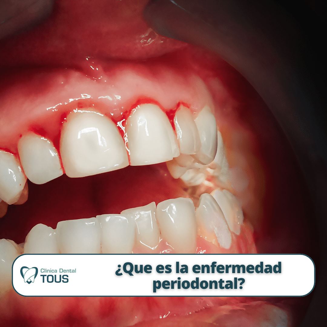La enfermedad periodontal, que es, qué la causa y cómo prevenirla