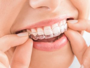 Ortodoncia invisible y fija en Palma de Mallorca | Clínica Dental Tous