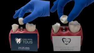 Implantes dentales den Palma de Mallorca | Clínica Dental Tous
