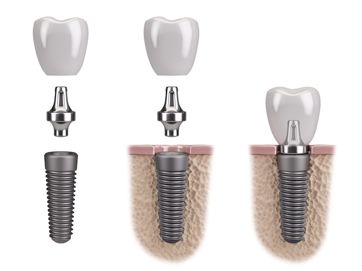 Precios del implante dental ¿Cuanto cuesta un implante dental?