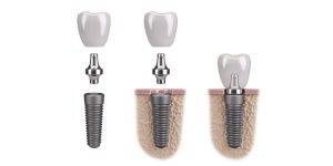 Precios del implante dental ¿Cuánto cuesta un implante dental? portada