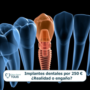 Implantes dentales por 250 euros ¿Realidad o engaño? - portada