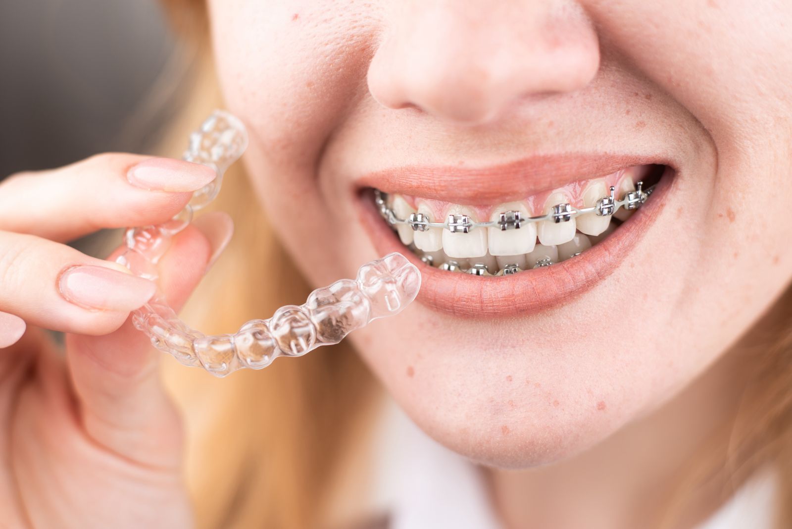 Guía rápida de tipos de ortodoncia Encuentra la mejor opción para ti