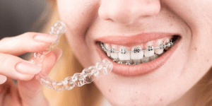 Guía rápida de tipos de ortodoncia Portada