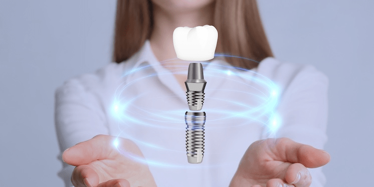 ¿Duelen los implantes dentales? Descubre la verdad detrás del proceso