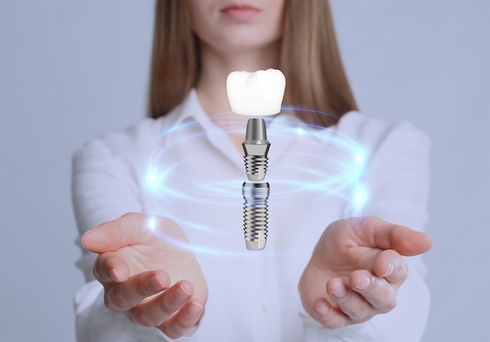 ¿Qué puedes esperar durante el proceso de implantes dentales?